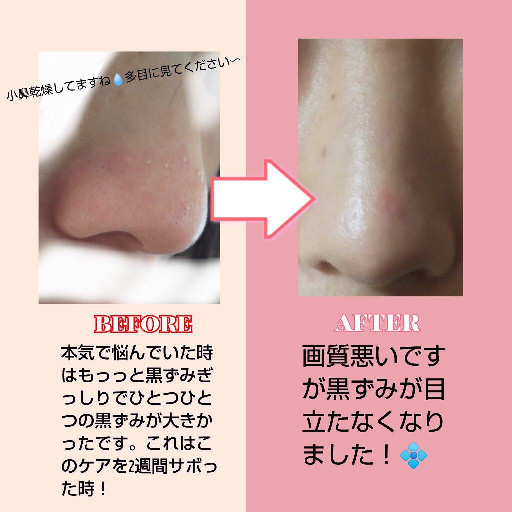 ジョンソン ベビーオイル 無香料/ジョンソンベビー/ボディオイルを使ったクチコミ（2枚目）