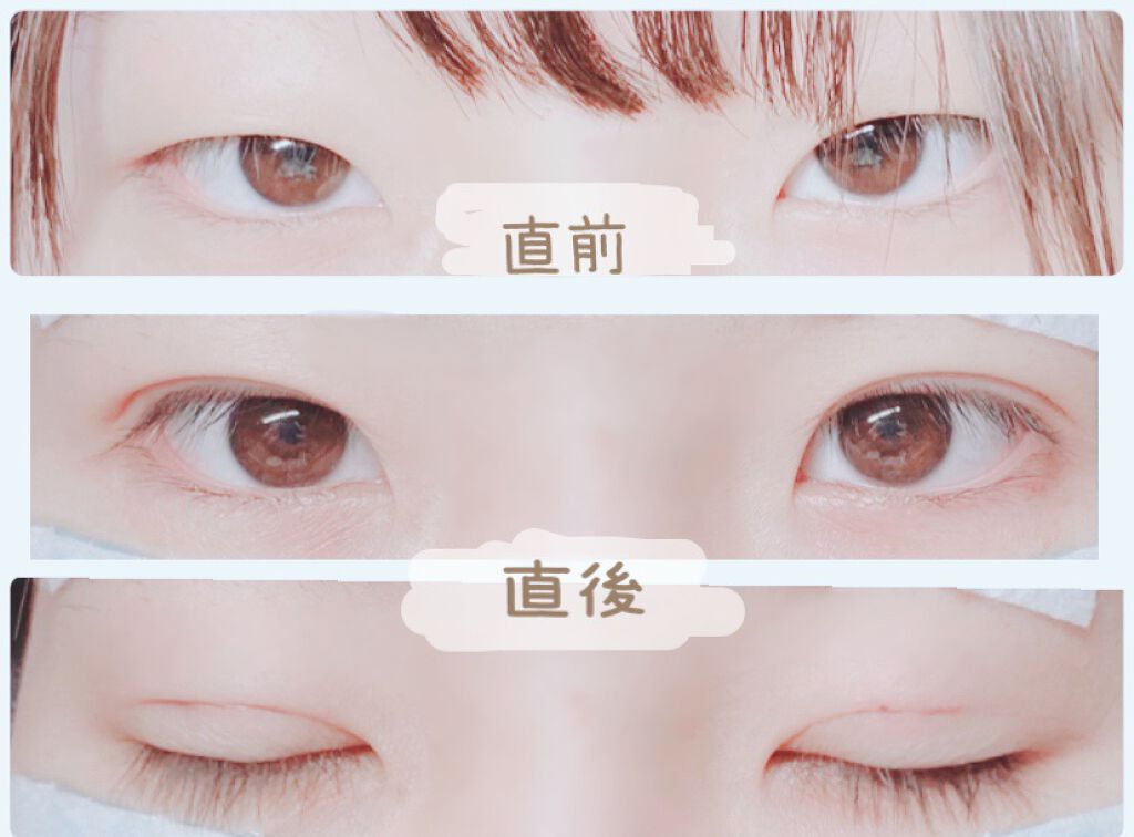 二重整形/その他を使ったクチコミ（2枚目）