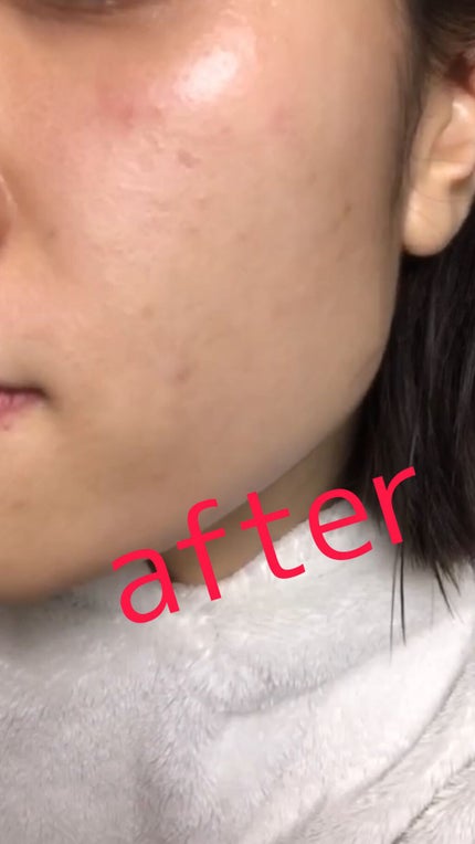 薬用 しみ 集中対策 美容液/メラノCC/美容液を使ったクチコミ(2枚目)