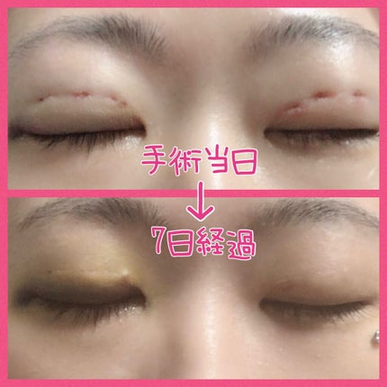 みぃ♔相互フォロー100% on LIPS 「※目の写真注意おはようございます🐣早くも7日が経過しました…4..」(6枚目)