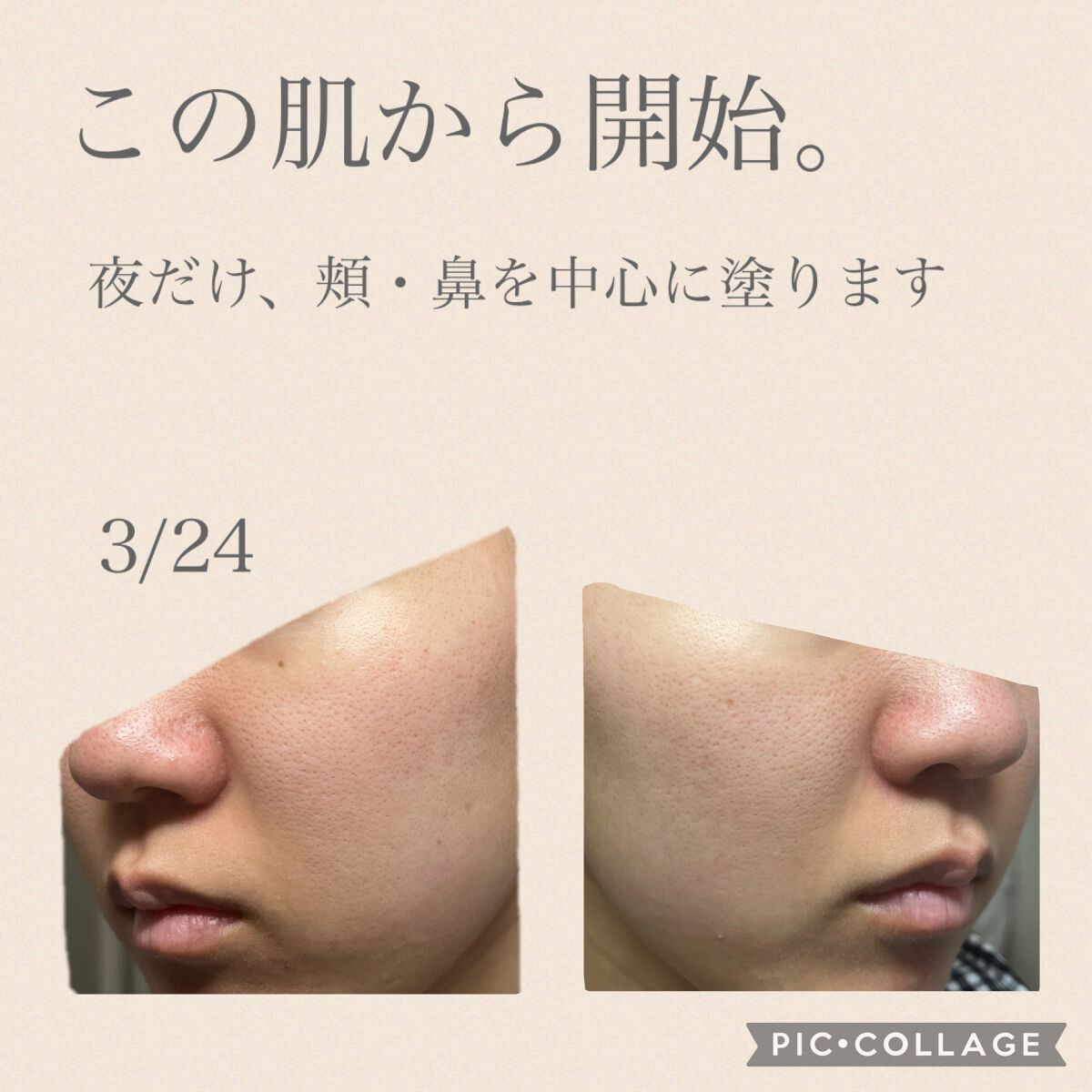 シカレチA エッセンス0.1/VT/美容液を使ったクチコミ(3枚目)