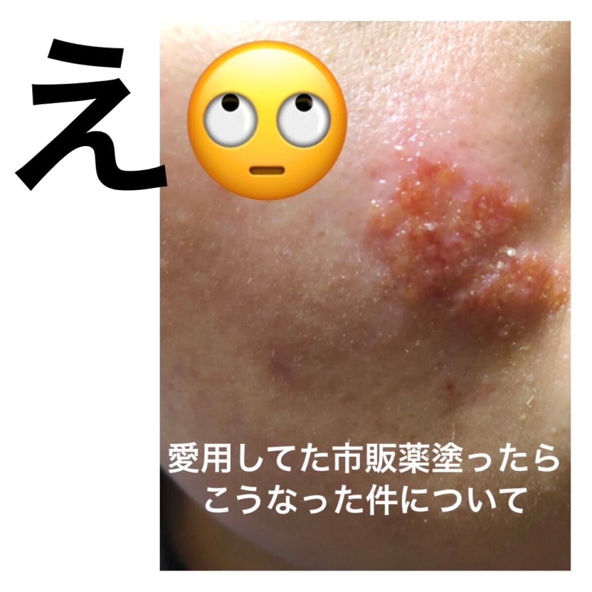 クロロマイセチン軟膏2%A(医薬品)/クロマイ/その他を使ったクチコミ(1枚目)