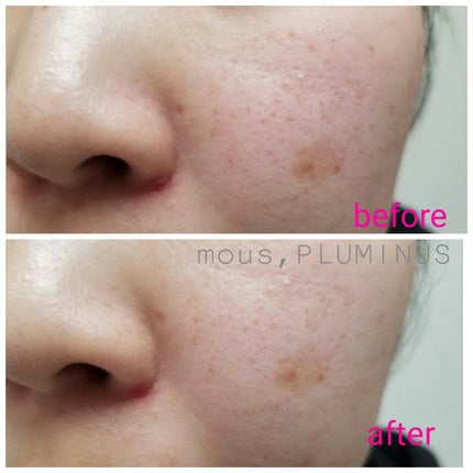 PLUMINUS/mous./美顔器・マッサージを使ったクチコミ(6枚目)