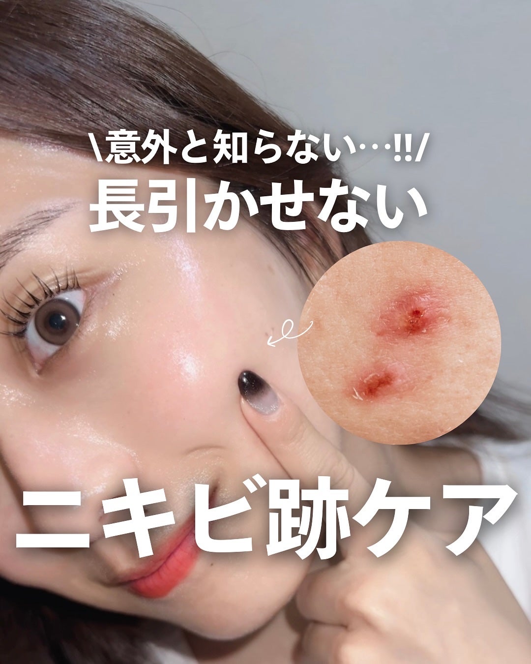 ナラ|毛穴ケアオタク🍓 on LIPS 「..こんばんは、ナラです🧚🏼♀ いきなりだけどニキビ跡のケア..」(1枚目)