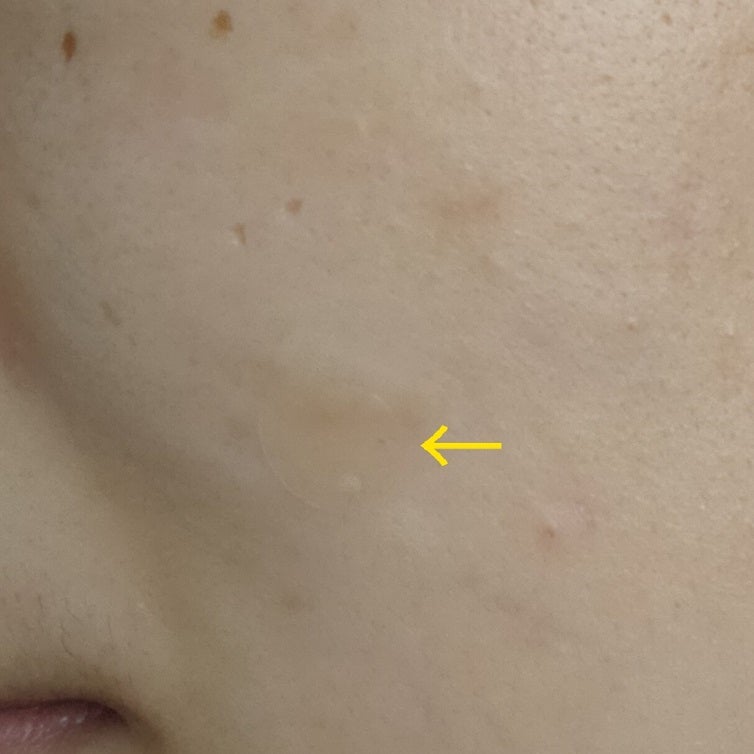 ビューティー スポットパッチ/イージーダムビューティー/にきびパッチを使ったクチコミ(3枚目)