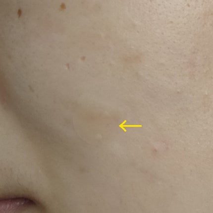 ビューティー スポットパッチ/イージーダムビューティー/にきびパッチを使ったクチコミ(3枚目)