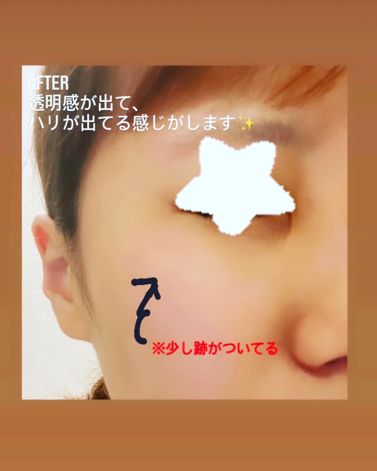 クリアターン ヒアロチューン マイクロパッチ 1500/クリアターン/シートマスク・パックを使ったクチコミ(4枚目)