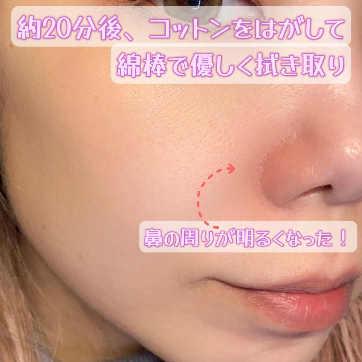 アクレオンセボエクストラクター/ANACIS/その他スキンケアを使ったクチコミ(4枚目)