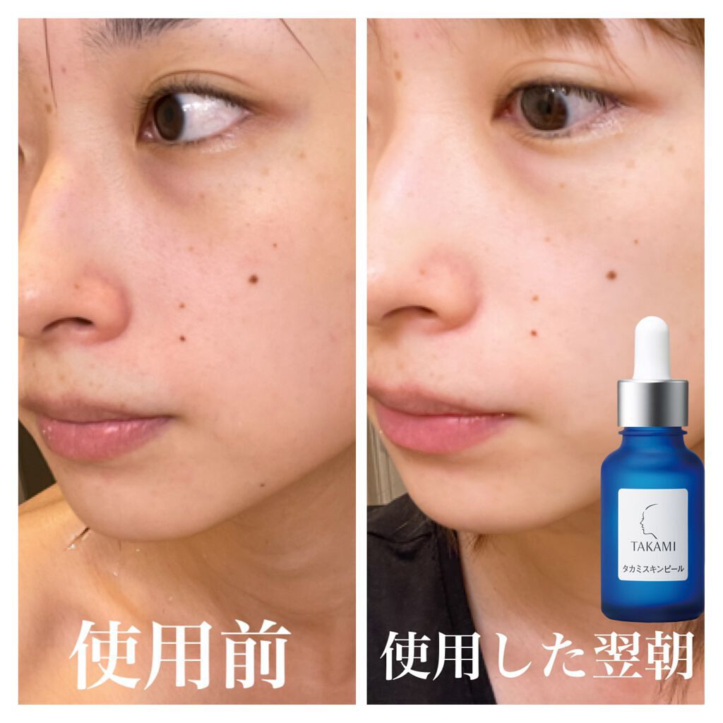 一部予約販売】 新品未使用 タカミ スキンピール 30ml