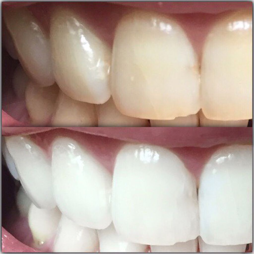 HAKUVES ホワイトニングジェル/HAKUVES/歯磨き粉を使ったクチコミ(2枚目)