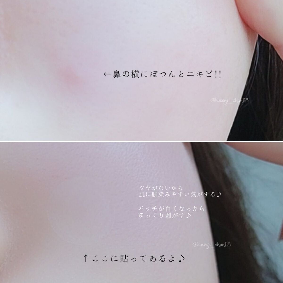 プロCICA クリアスポットパッチ/VT/その他スキンケアを使ったクチコミ(3枚目)