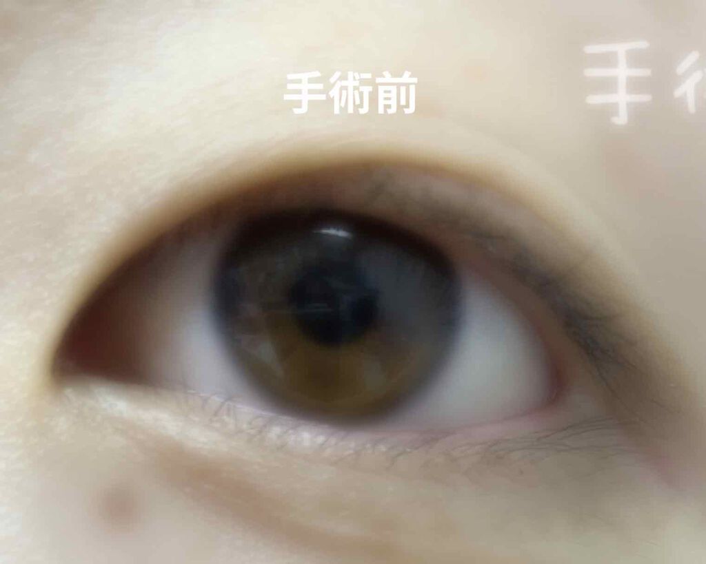 二重整形/その他を使ったクチコミ（2枚目）