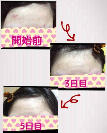 薬用 しみ 集中対策 美容液/メラノCC/美容液を使ったクチコミ(4枚目)