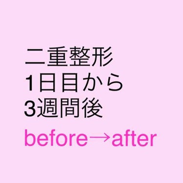 ⚠️目の写真あります⚠️

＿＿＿＿＿＿＿＿＿＿＿＿＿＿＿＿＿＿＿＿＿
二重整形、1日目から3週間後の
Before Afterの写真です😊


一応メガネなしで人前に出れるようになったのは施術から5日