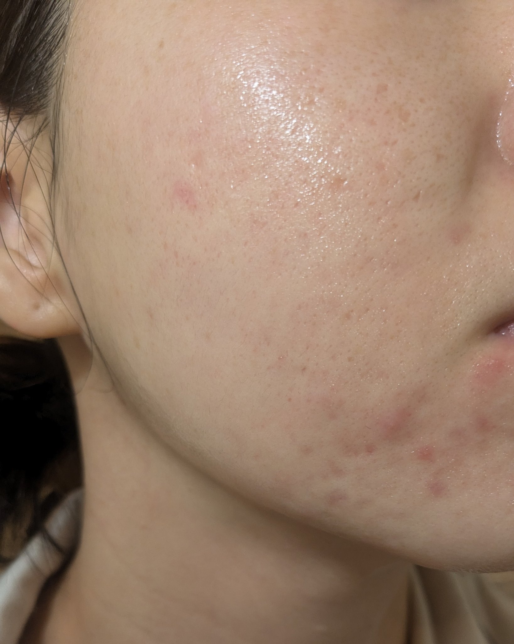 11/5の#汚肌工事録

冬はあご荒れやすいです😂まだ序章です…