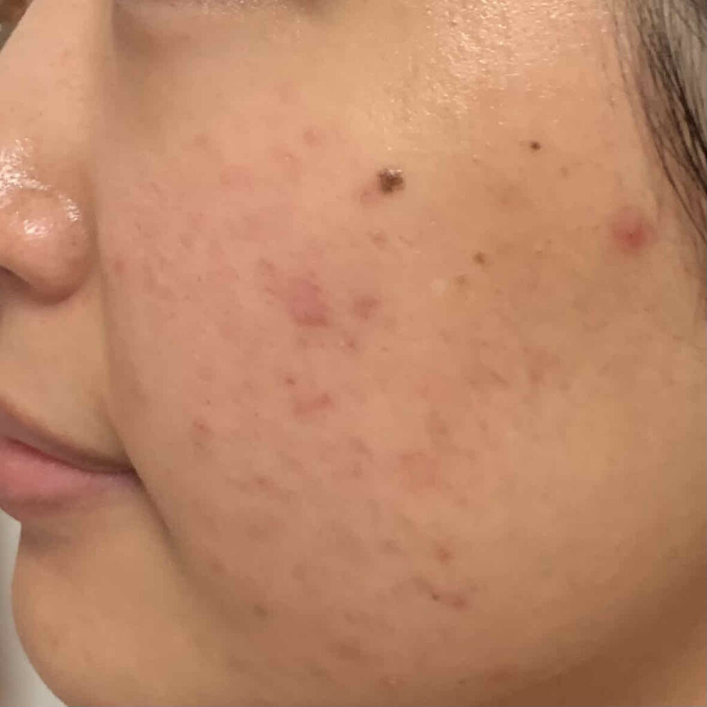 薬用 クリアローション M(しっとりタイプ)/オルビス/化粧水を使ったクチコミ（1枚目）