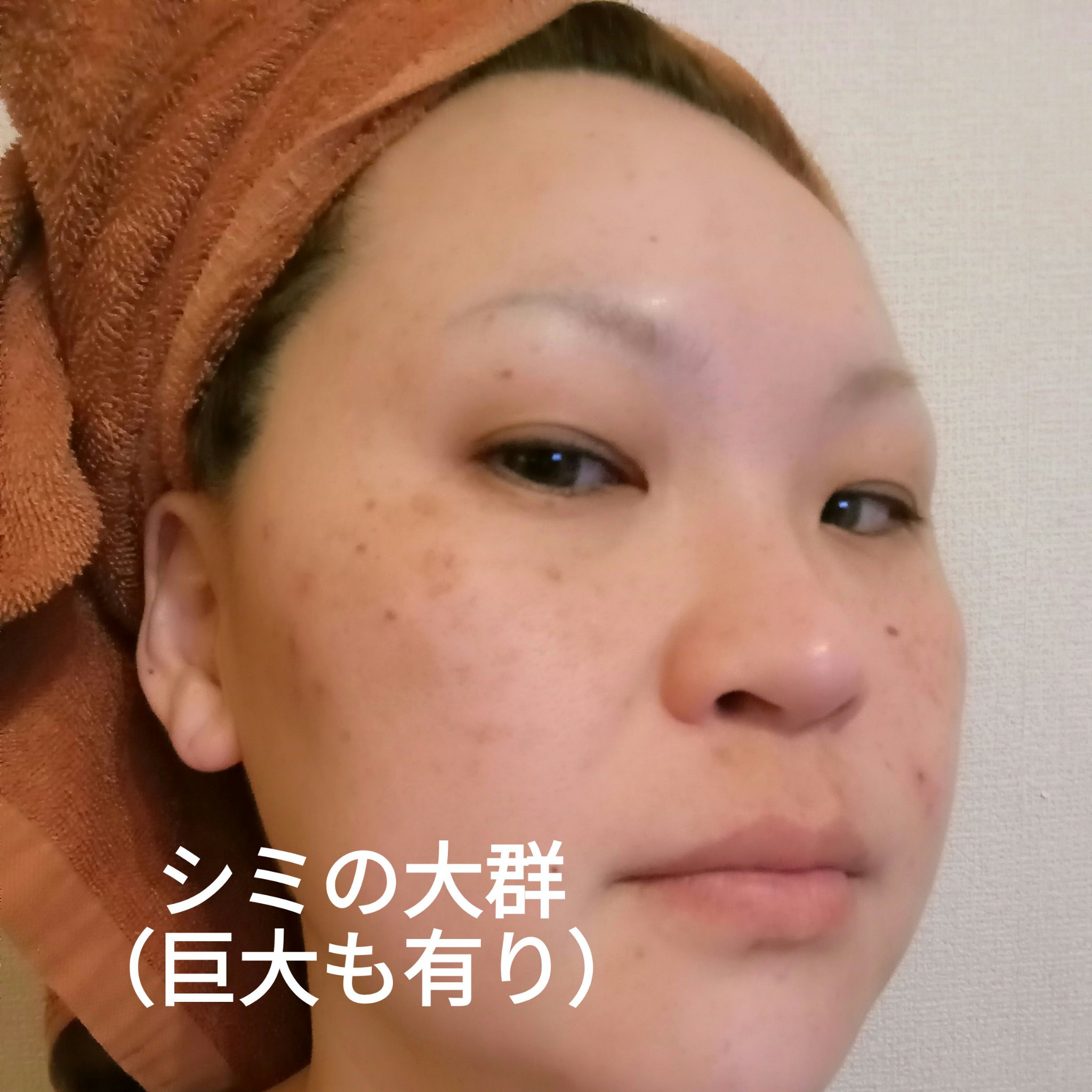 IPLフォトダブル/湘南美容/その他を使ったクチコミ（2枚目）