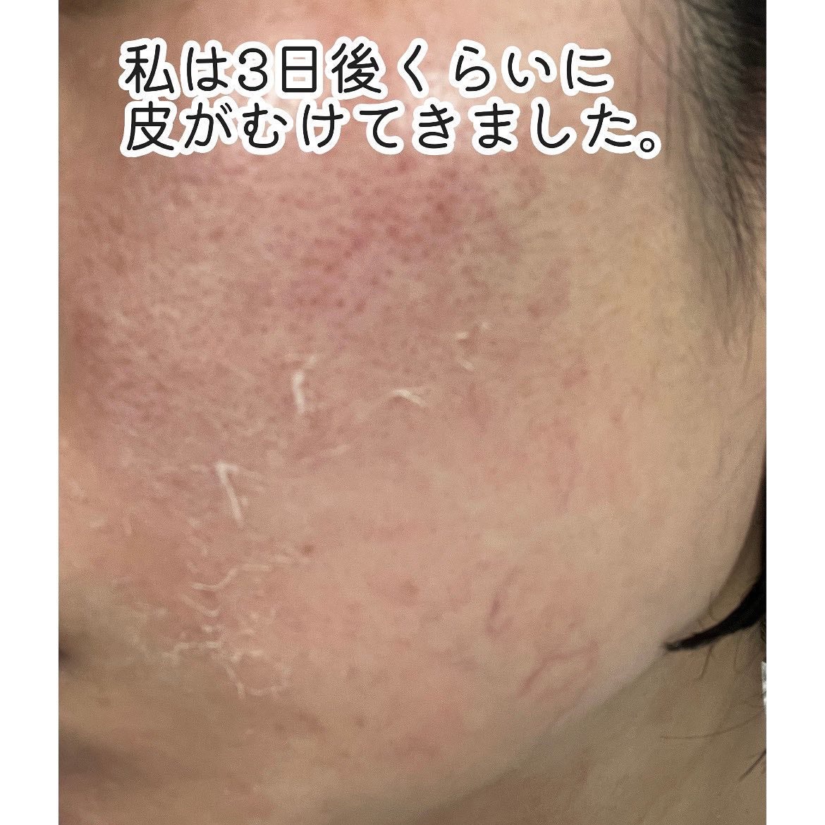 ダーマスキンピーリング/BQCELL/その他キットセットを使ったクチコミ(4枚目)
