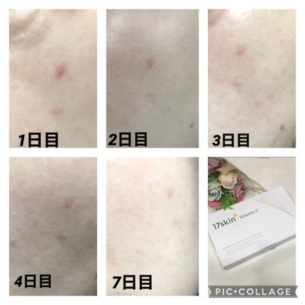 高濃度ビタミンC/17skin/美容サプリメントを使ったクチコミ(4枚目)