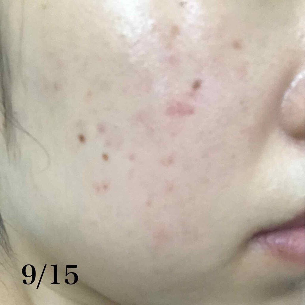 1週間お手入れキット/ルナメアAC/トライアルキットを使ったクチコミ（3枚目）