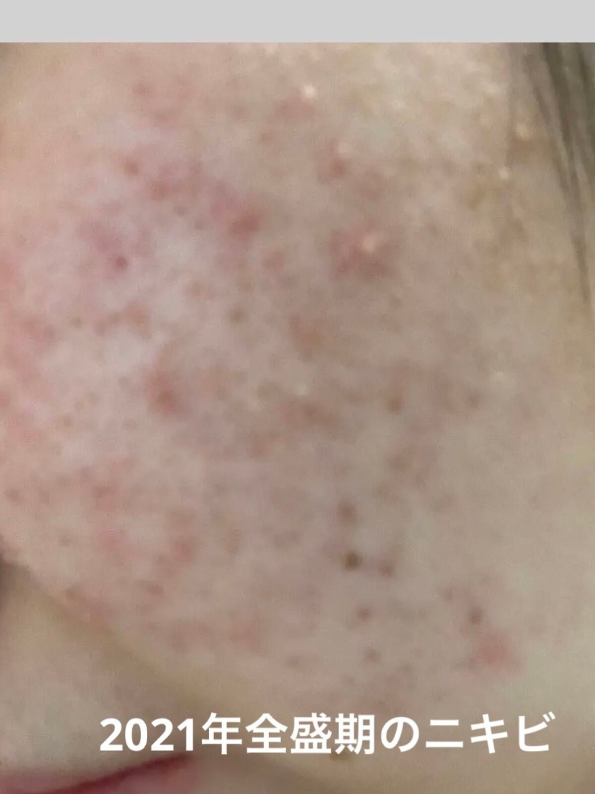 ちひろ on LIPS 「 私のニキビが終わりを迎えようとしています。そして、ニキビの全..」(3枚目)