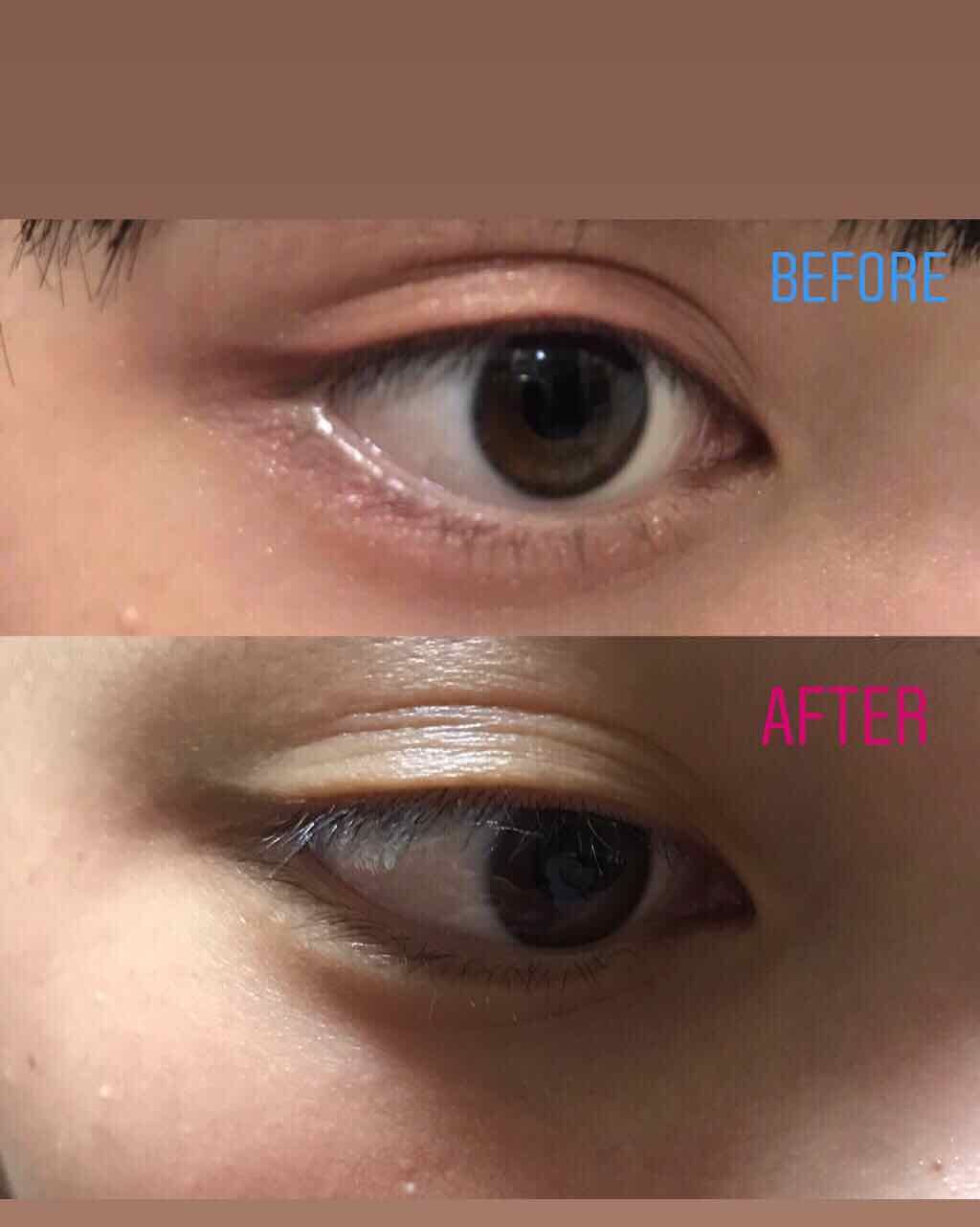 みこあ·͜·ᰔᩚ on LIPS 「〜白いニキビを治す方法〜前にニキビが出来たことがあったのですが..」(1枚目)