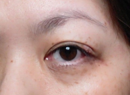 キュアレア(医薬品)/キュアレアa/その他を使ったクチコミ(1枚目)