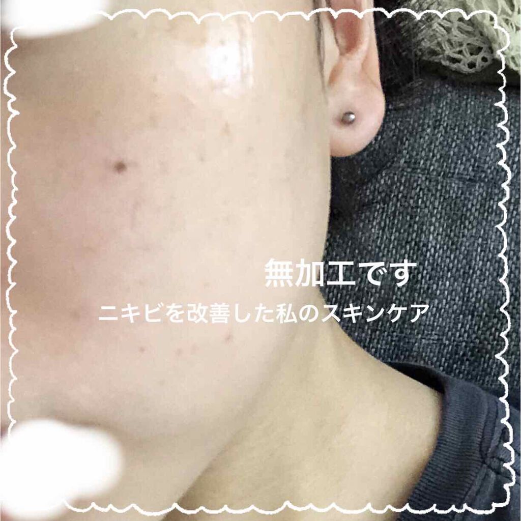 ベピオゲル/マルホ株式会社/その他を使ったクチコミ（1枚目）