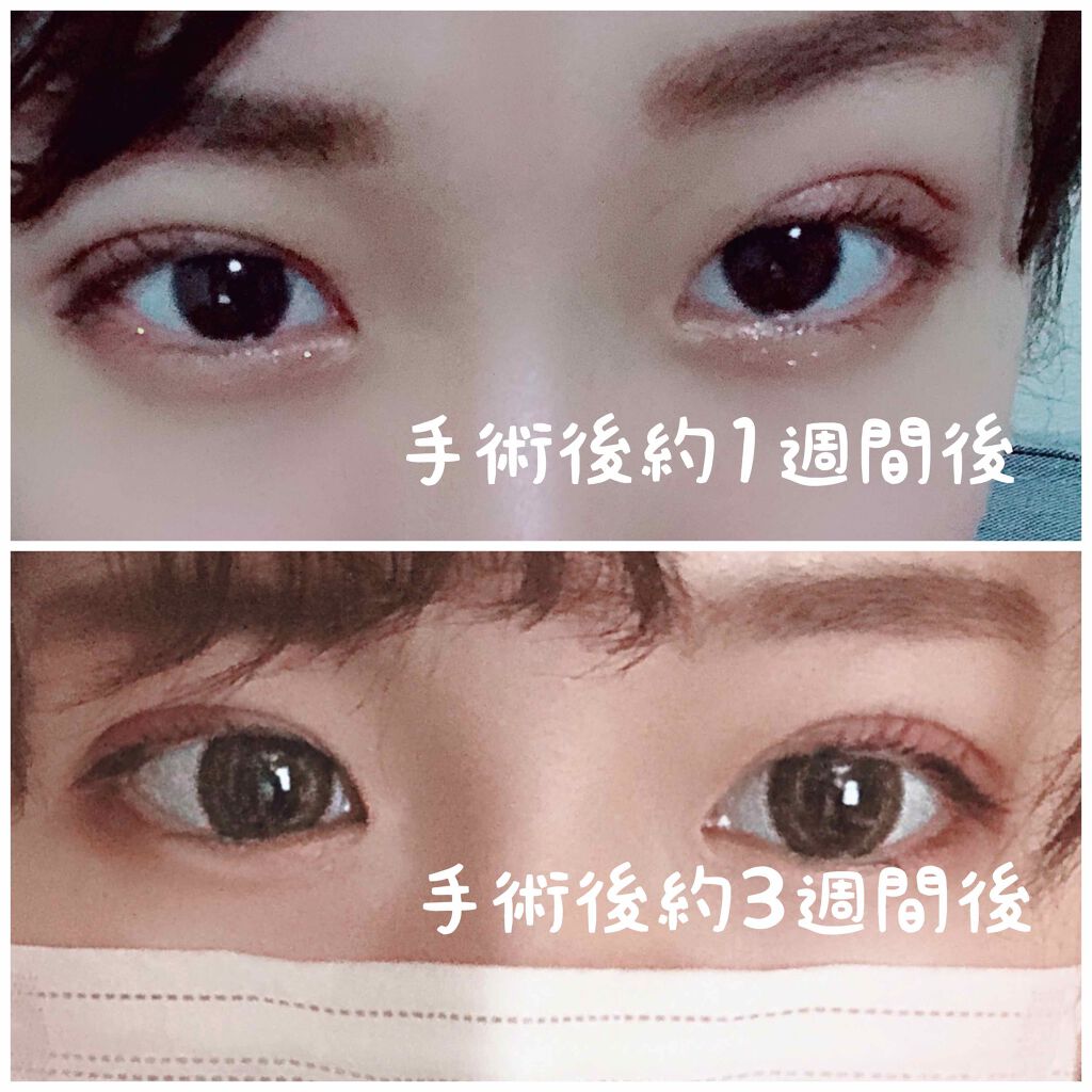 二重整形/その他を使ったクチコミ（3枚目）