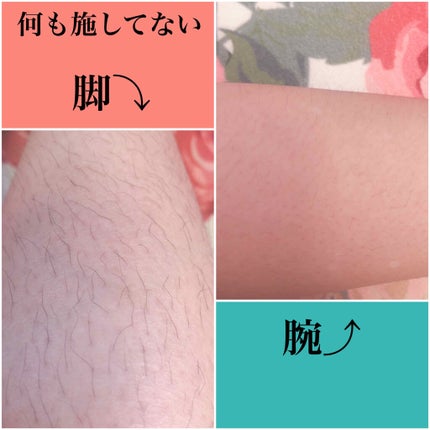Aminzer IPL光脱毛器/Aminzer/家庭用脱毛器を使ったクチコミ(2枚目)
