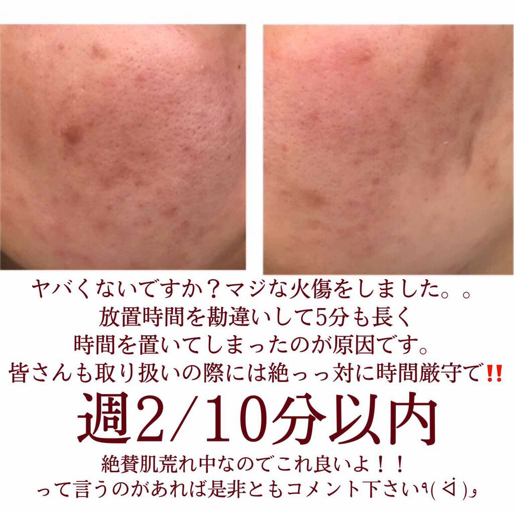 AHA 30% + BHA 2% Peeling Solution/The Ordinary/ピーリングを使ったクチコミ（3枚目）
