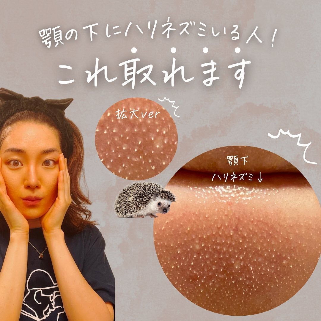 おゆみ|ニキビ・ニキビ跡ケア on LIPS 「@______ohyoume他の投稿【顎下のハリネズミを抹消し..」(2枚目)