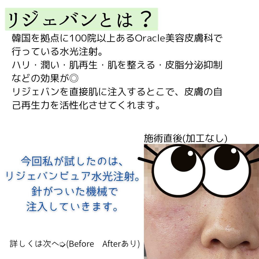 Lim(コスメコンシェルジュ) on LIPS 「初の美容医療!オラクル美容皮膚科にて、リジェバンピュアのモニタ..」(2枚目)
