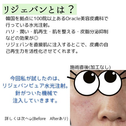 Lim(コスメコンシェルジュ) on LIPS 「初の美容医療!オラクル美容皮膚科にて、リジェバンピュアのモニタ..」(2枚目)