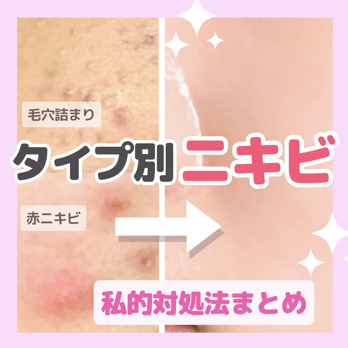 ペアアクネクリームW(医薬品)/ペア/その他を使ったクチコミ（1枚目）