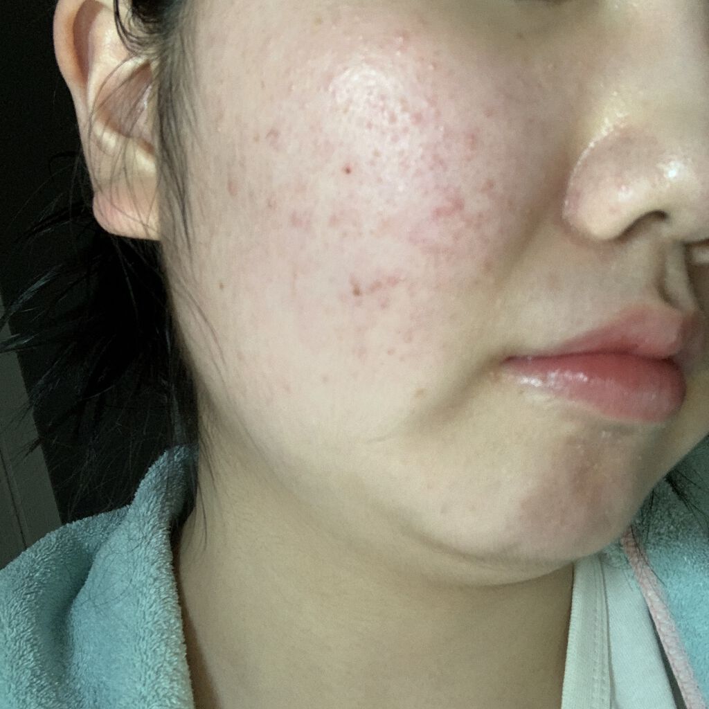 A アクネローション/NOV/化粧水を使ったクチコミ（1枚目）