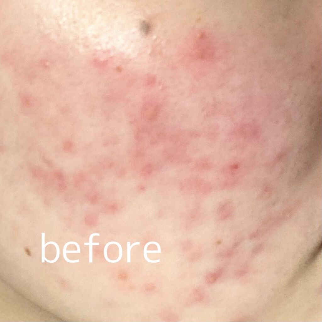 ディフェリンゲル0.1% /マルホ株式会社/その他を使ったクチコミ（2枚目）