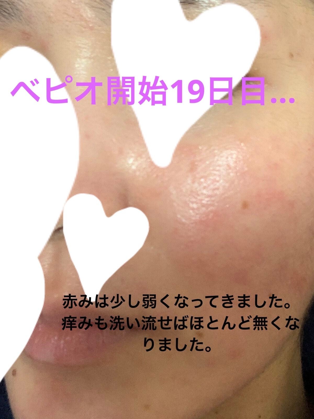 ルルルンピュア エブリーズ/ルルルン/シートマスク・パックを使ったクチコミ(5枚目)