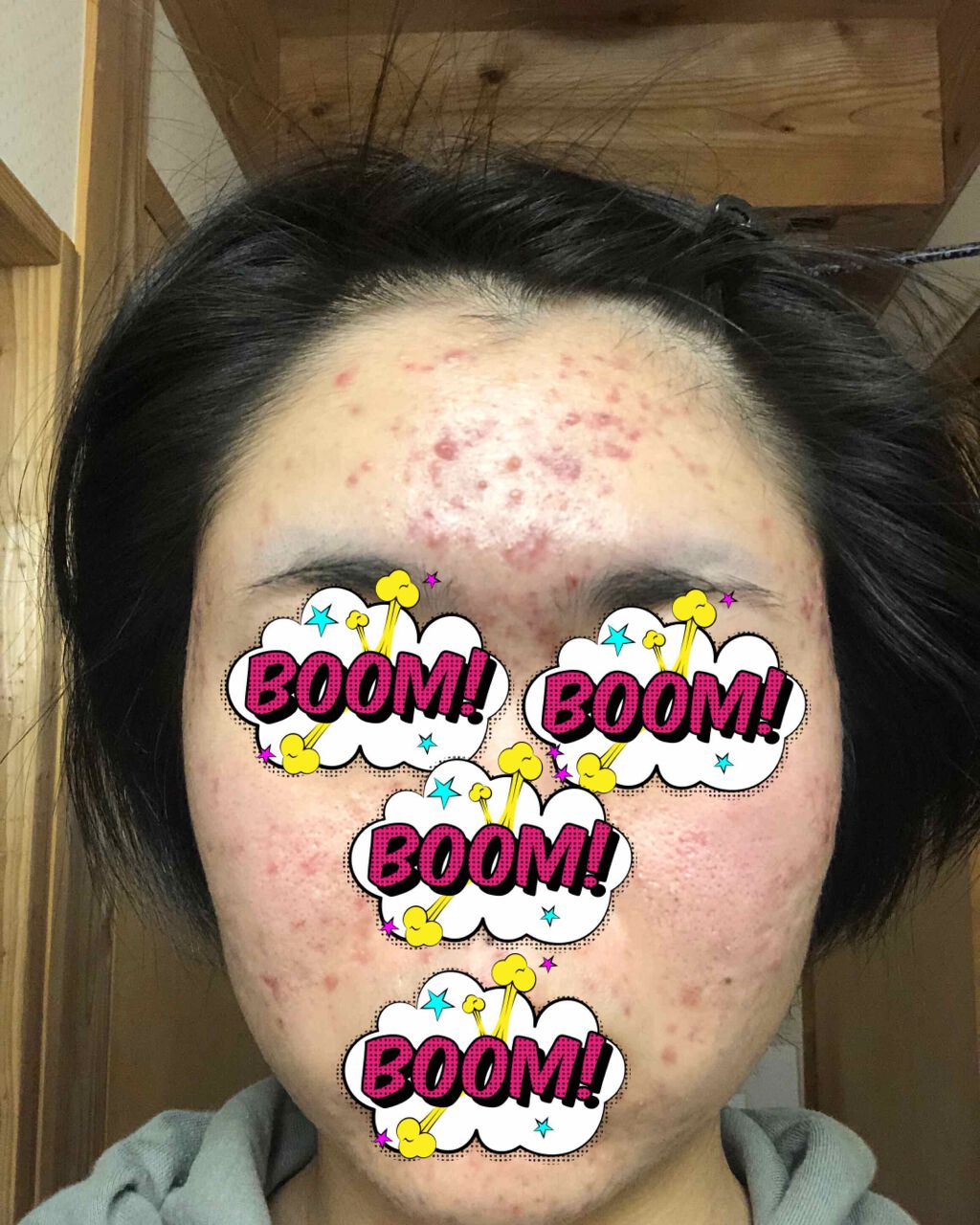 ふゆ on LIPS 「ディフェリンゲルを使って1ヶ月経ちましたー!皆さんお久しぶりで..」(1枚目)