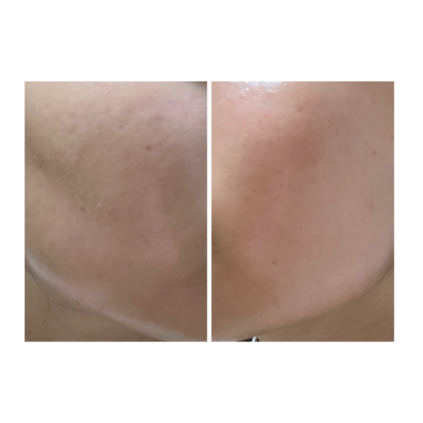 ぽむ on LIPS 「2023.9.13皮膚科に受診 エピデュオとヘパリン処方1枚目..」(2枚目)