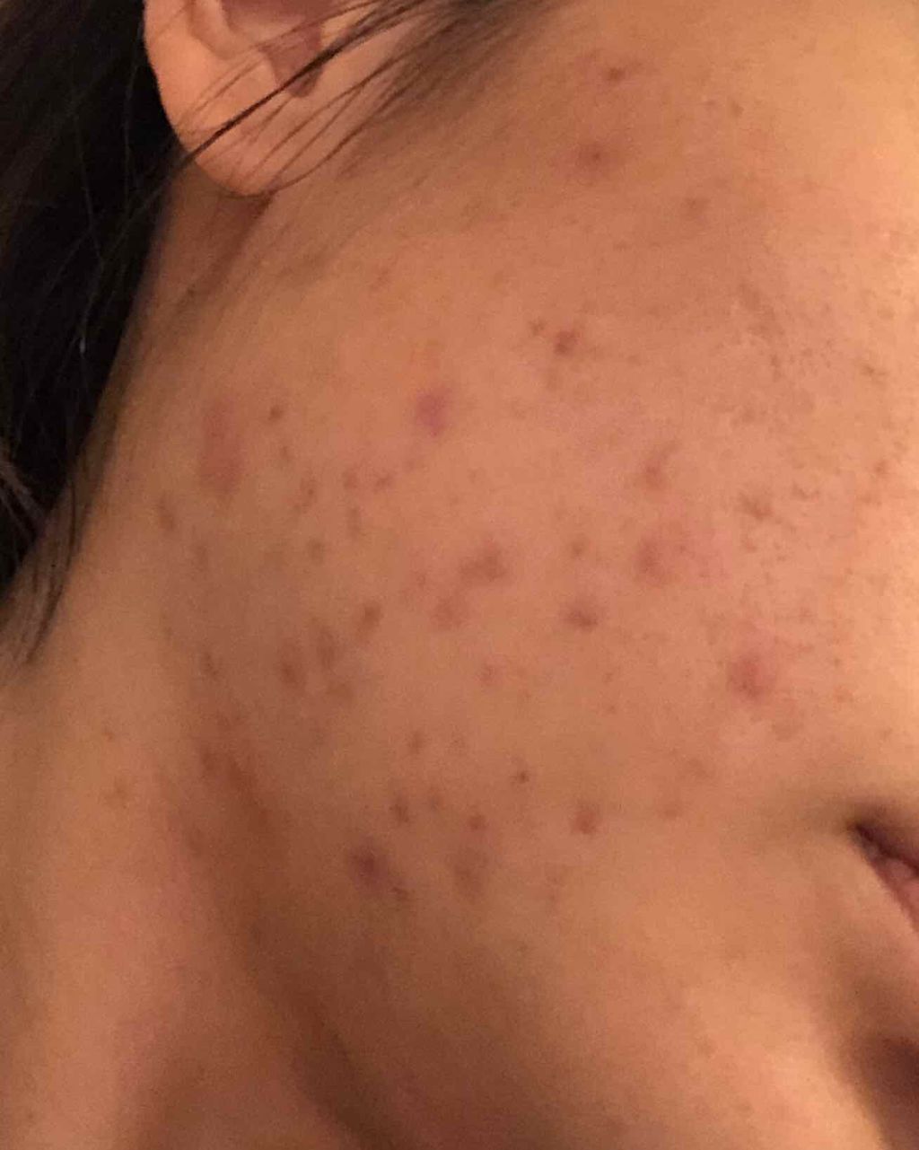 Bella on LIPS 「顎ニキビが1つあり、皮膚科の先生からよく効くよ!との事でデュア..」(3枚目)