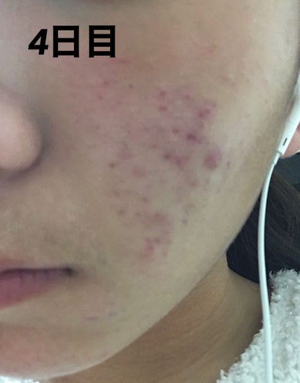 ニキビあとケアジェル/アットノン/その他スキンケアを使ったクチコミ(2枚目)