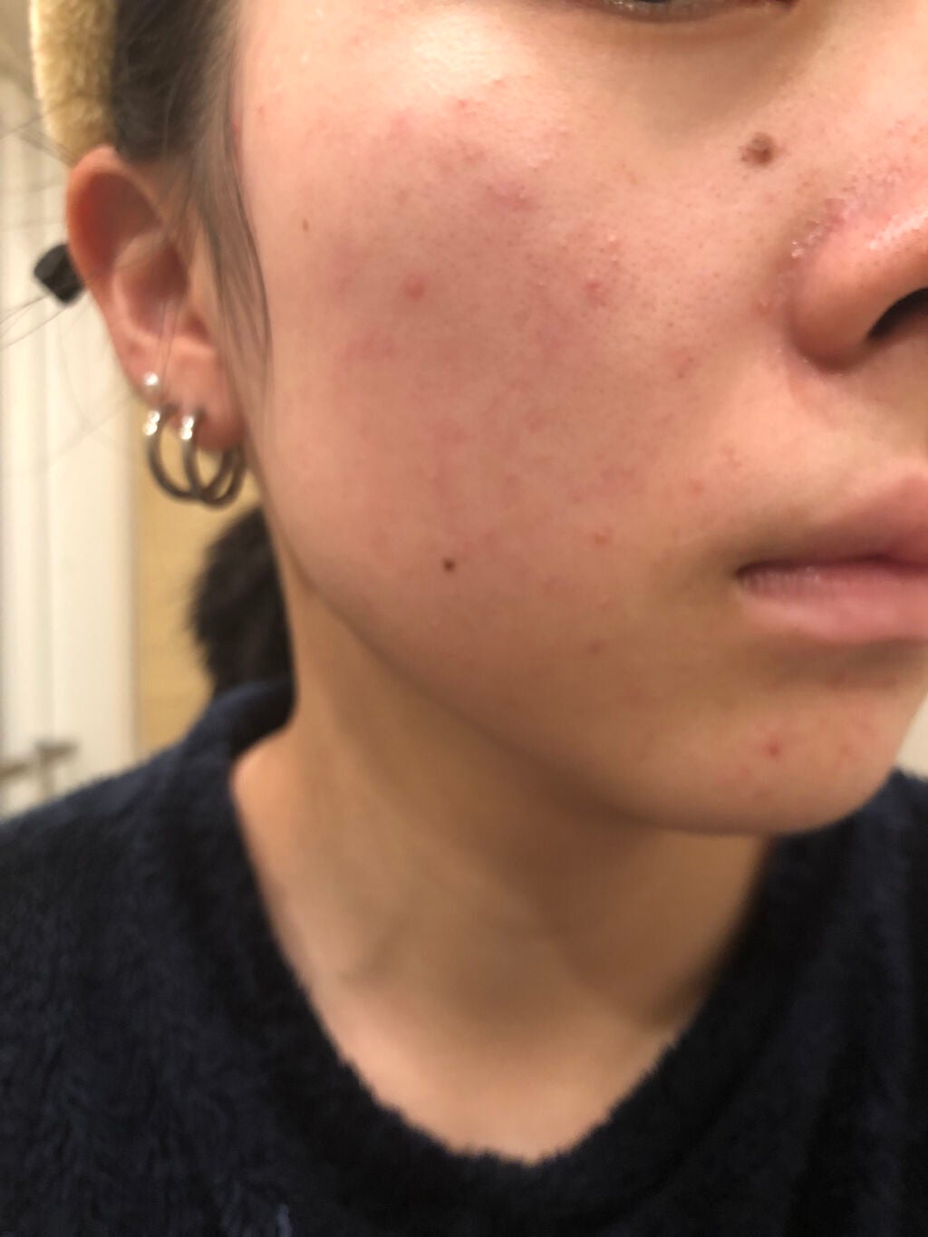 肌荒れ女子 on LIPS 「【閲覧注意⚠️】肌荒れ女子の肌断食日記📖2日目・・・・こんにち..」(3枚目)