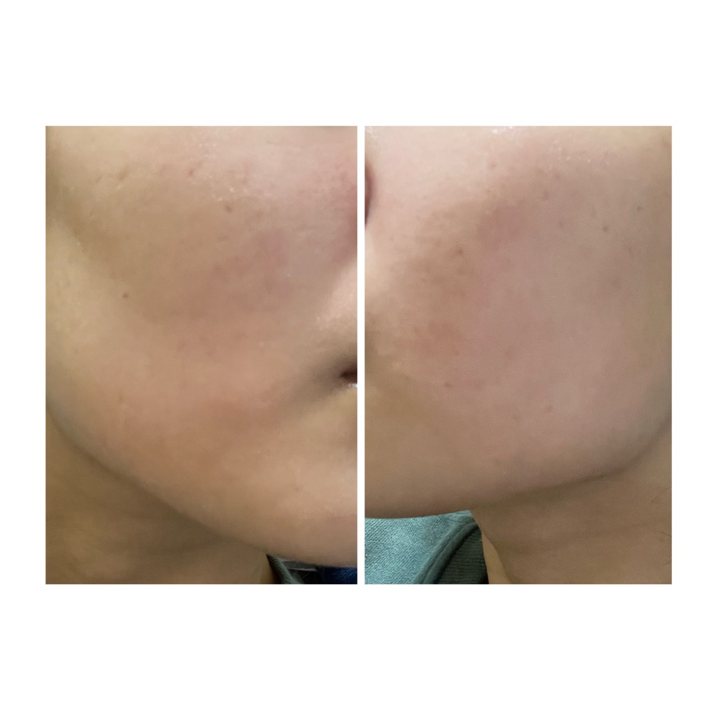 ぽむ on LIPS 「2023.9.13皮膚科に受診 エピデュオとヘパリン処方1枚目..」(5枚目)