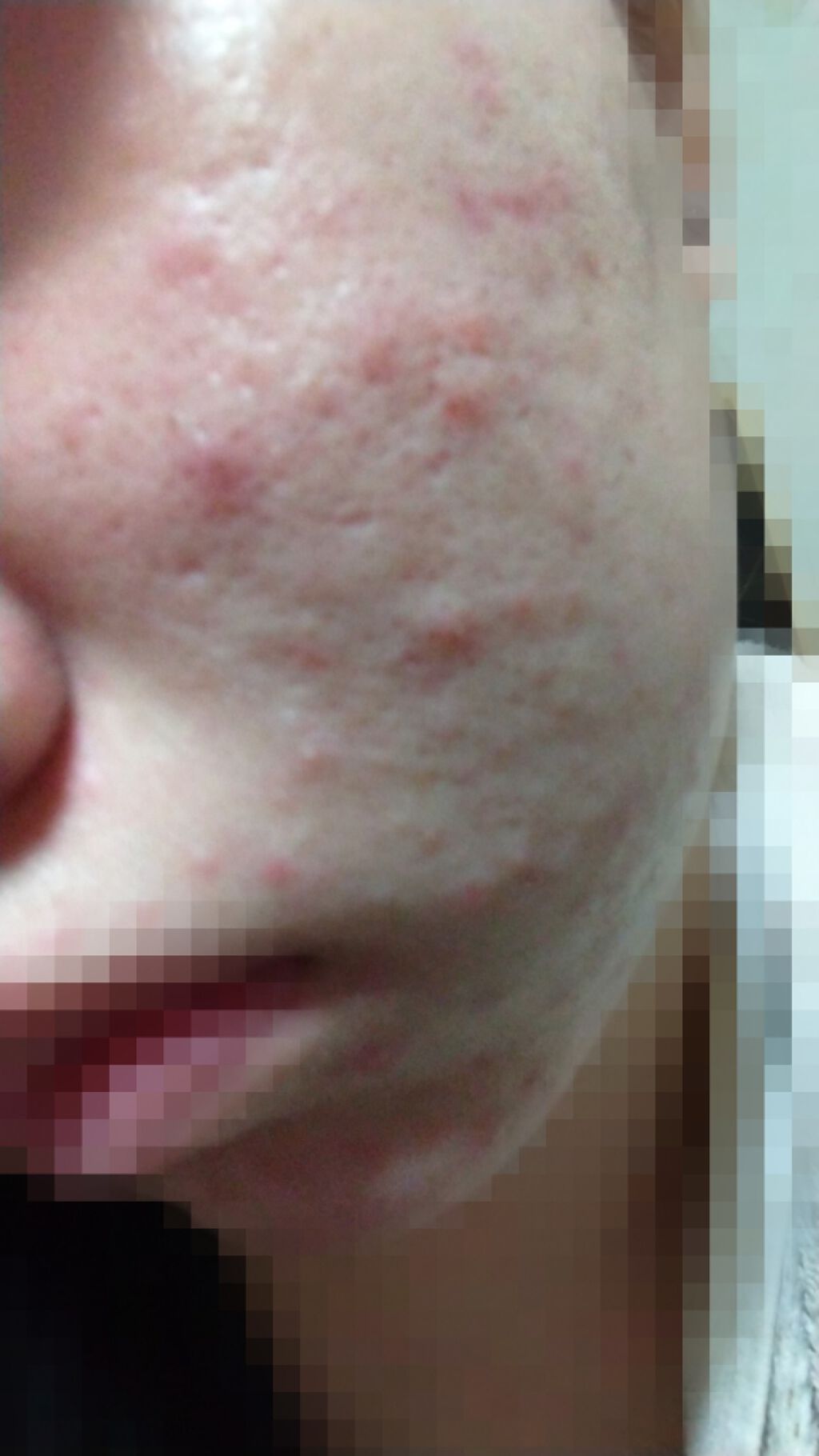 オロナインH軟膏 (医薬品)/オロナイン/その他を使ったクチコミ(2枚目)