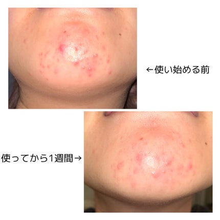 テラ・コートリル 軟膏(医薬品)/ジョンソン・エンド・ジョンソン/その他を使ったクチコミ(2枚目)