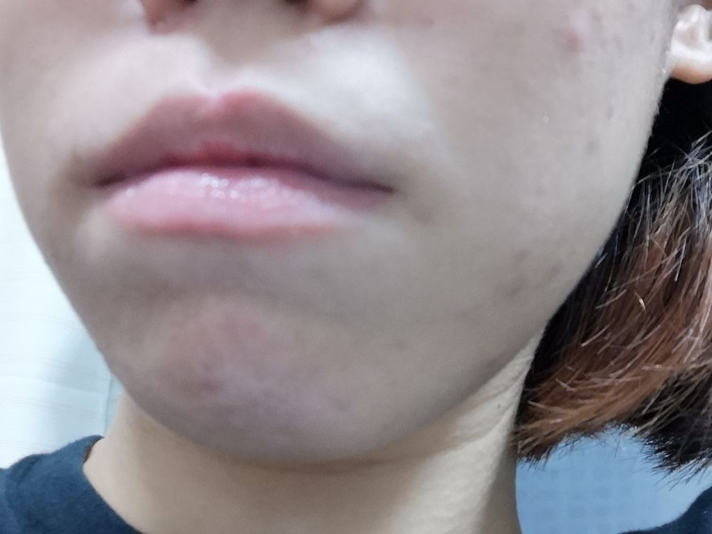 バイオイル/バイオイル/フェイスオイルを使ったクチコミ（2枚目）