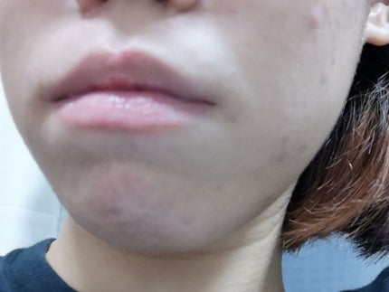 アクネキュアクリーム(医薬品)/IHADA/その他を使ったクチコミ(2枚目)