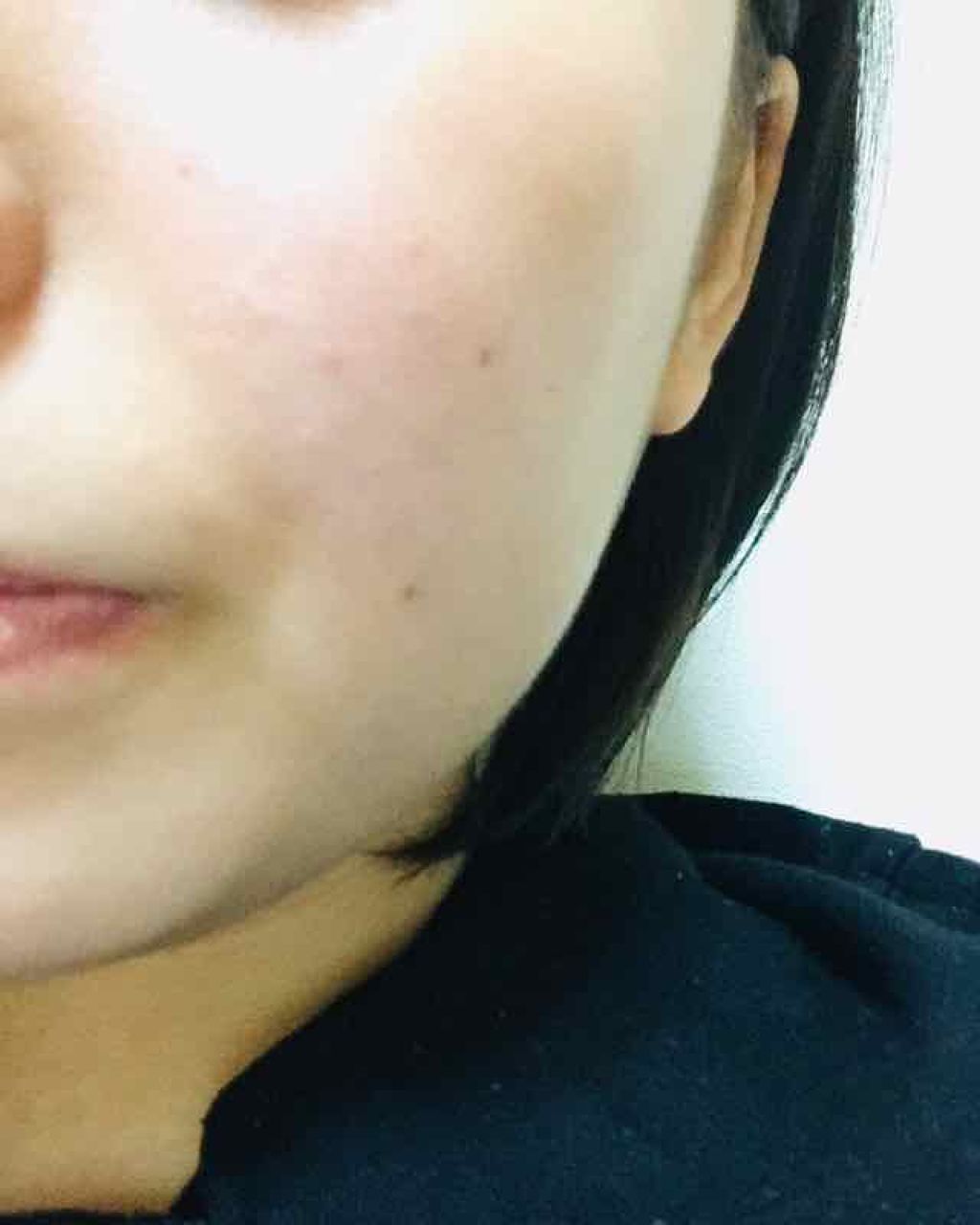 coral_rouge_w4if on LIPS 「ほくろ取りをすると決めました!肌荒れが改善しているかな?最初よ..」(1枚目)