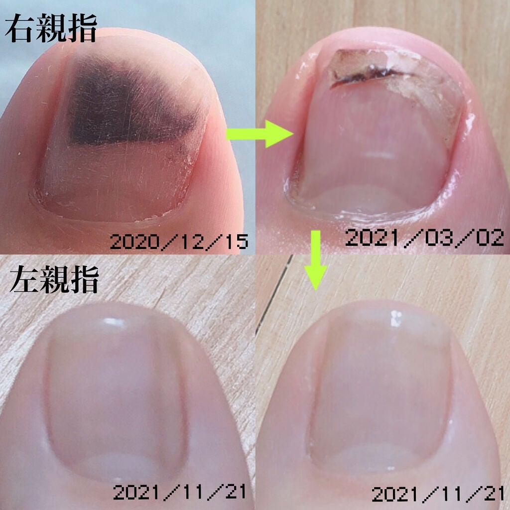 ネイルエンビー/O・P・I/ネイルオイル・トリートメントを使ったクチコミ(3枚目)